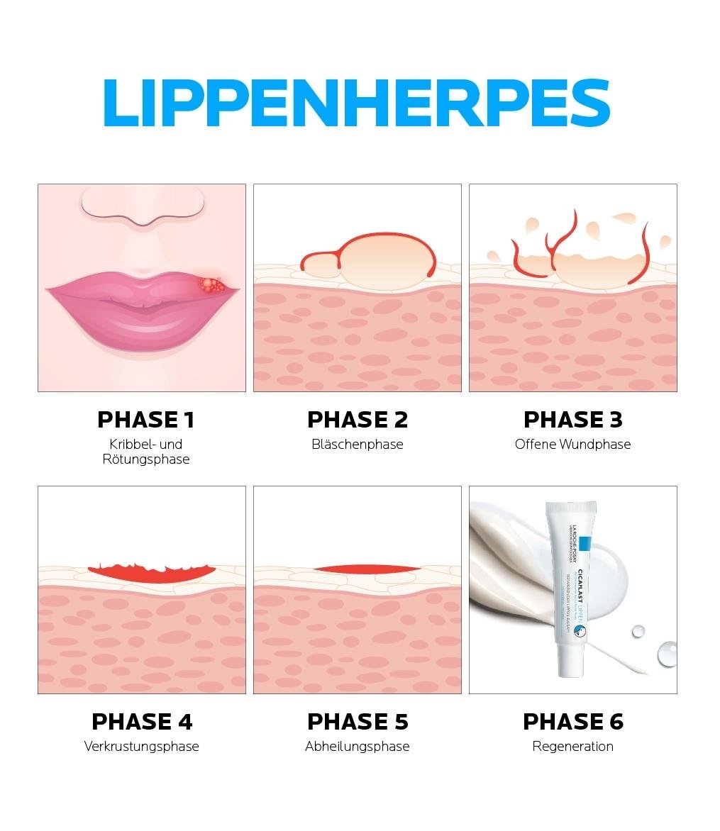 Lippenherpes: Grafische Darstellung der verschiedenen Phasen bei Lippenherpes