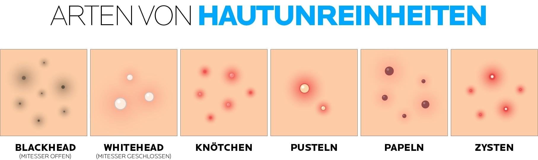 Grafische Darstellung der unterschiedlichen Arten von Hautunreinheiten