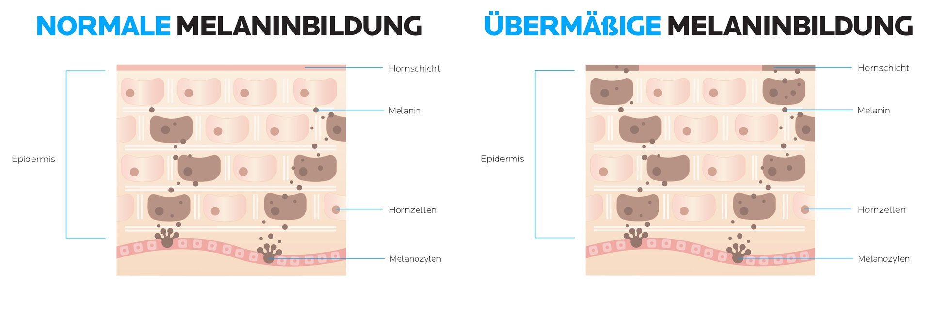 Darum entstehen Pigmentflecken: normale vs. übermässige Melaninbildung