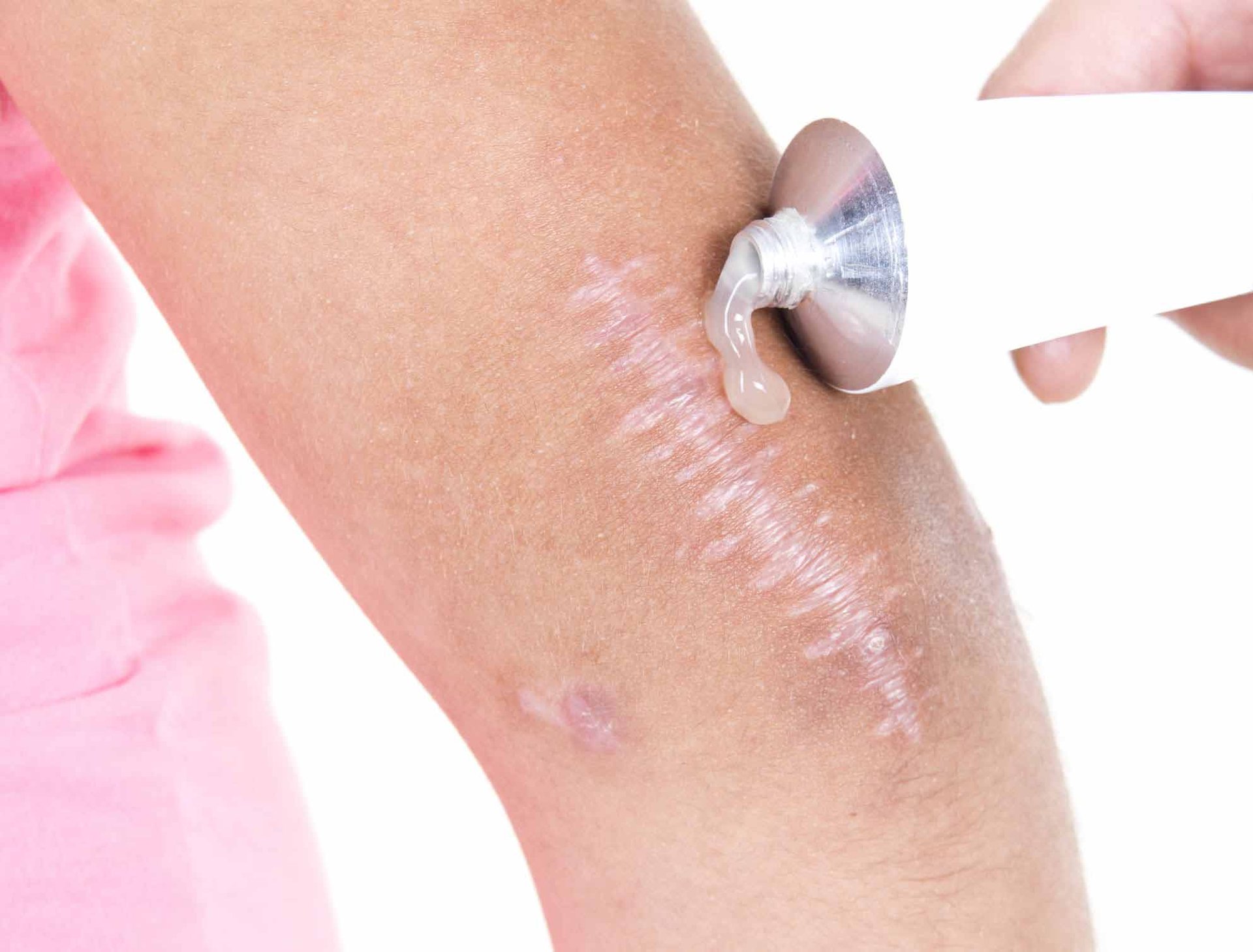Gel, das auf die Haut zur Narbenpflege aus einer Tube aufgetragen wird