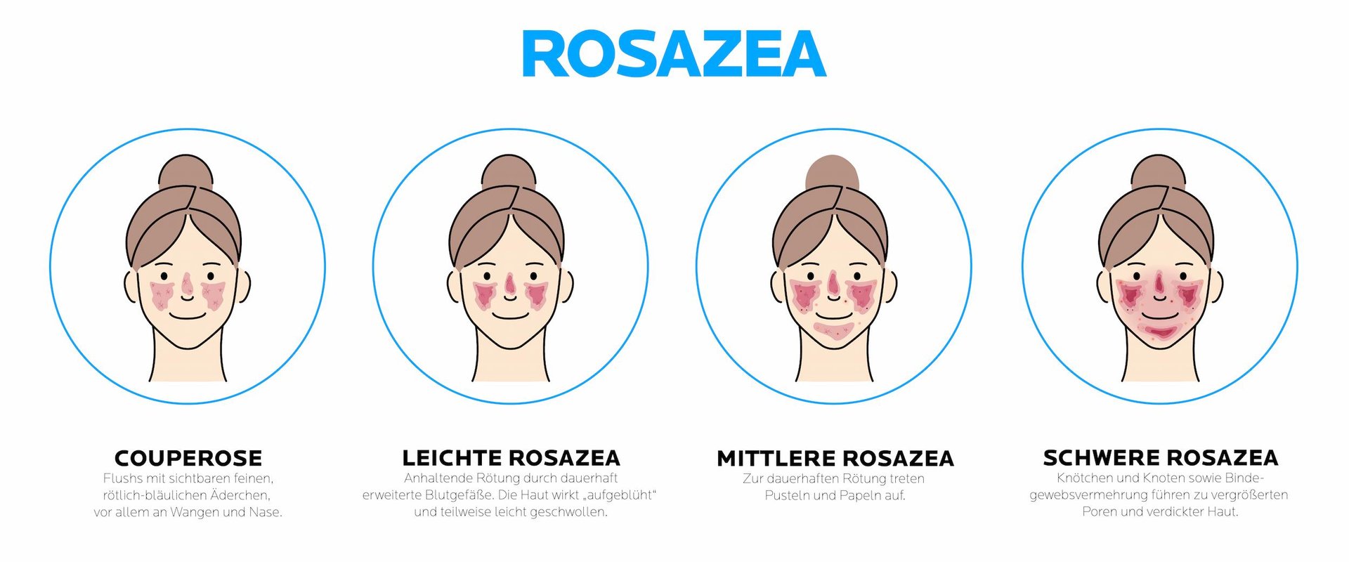 Grafik zeigt Rosazea in vier Stadien von Couperose bis zur schweren Rosazea.