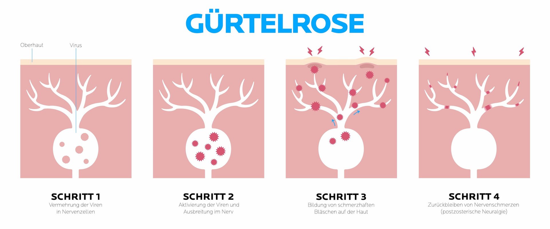 Grafik zur Entstehung von Gürtelrose in vier Stadien.