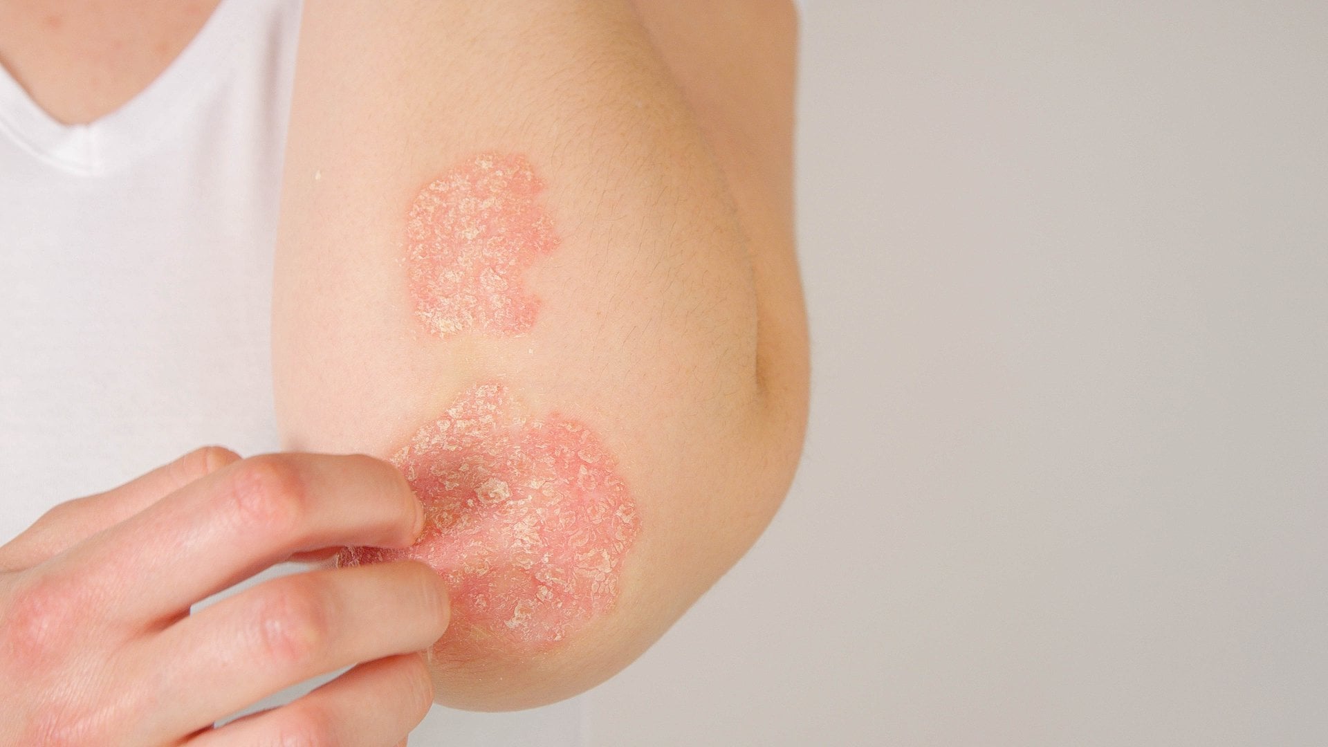 Frau fässt sich an eine Stelle mit Schuppenflechte (Psoriasis) an ihrem Ellenbogen