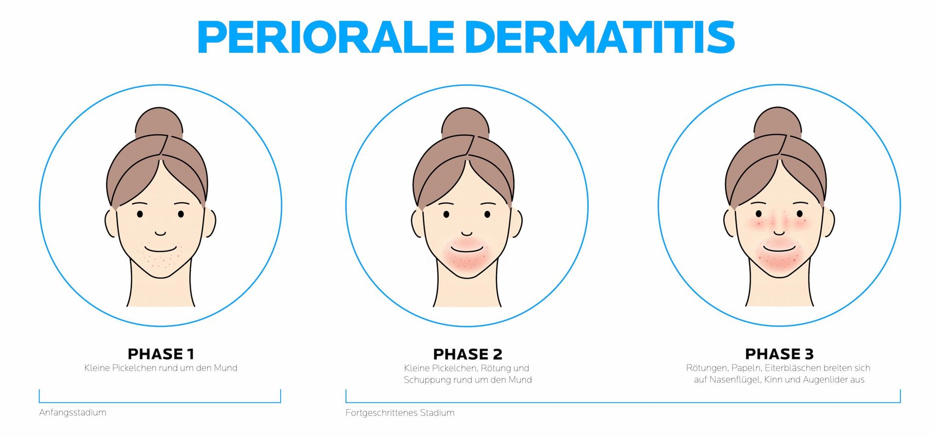 Grafik zeigt periorale Dermatitis in drei Phasen mit zunehmenden Rötungen und Pusteln um Mund und Gesicht.