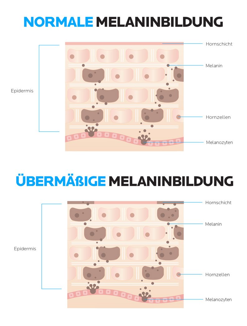 So entstehen Pigmentstörungen: normale vs. Übermäßige Melaninbildung